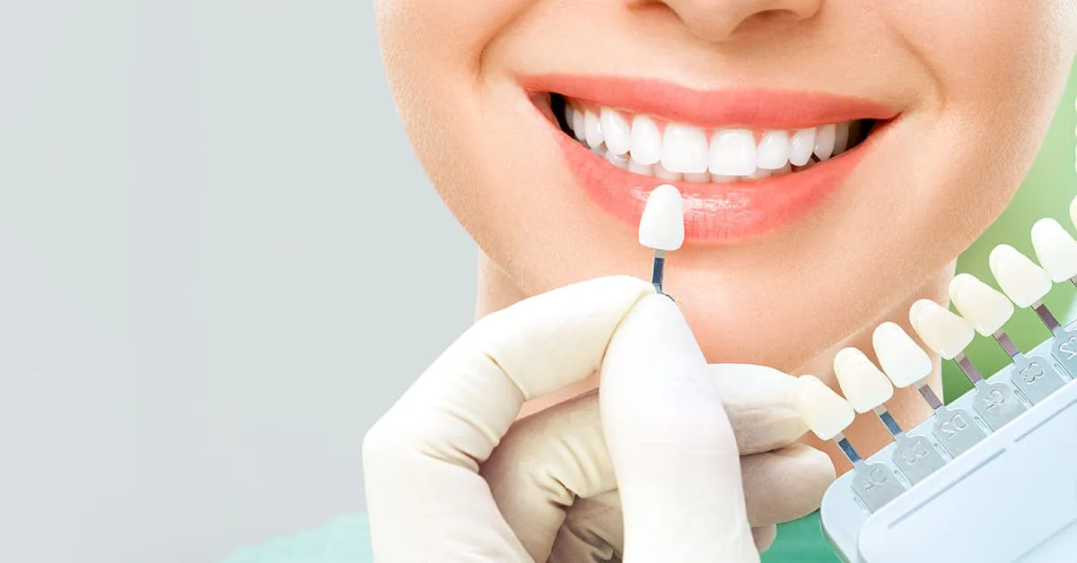 Carillas dentales: todo lo que tienes que saber